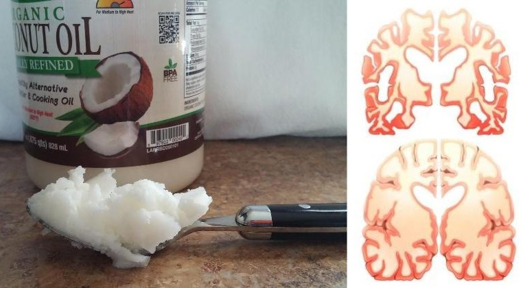 Man Eats 2 Tbs of Coconut Oil Twice a Day for 60 Days and This Happens to His Brain!